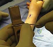 صورة توضيحية لـ كسور عظمي الساعد عند الأطفال: العلاج المتقدم بالمسامير المرنة داخل النخاع مع الأستاذ الدكتور محمد هطيف