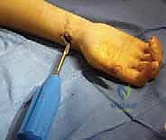 صورة توضيحية لـ كسور عظمي الساعد عند الأطفال: العلاج المتقدم بالمسامير المرنة داخل النخاع مع الأستاذ الدكتور محمد هطيف