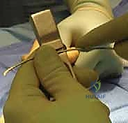 مقارنة بين الجبس والجراحة في علاج كسور الساعد