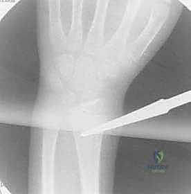 كسور عظمي الساعد عند الأطفال: العلاج المتقدم بالمسامير المرنة داخل النخاع مع الأستاذ الدكتور محمد هطيف