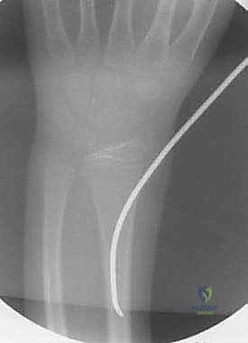 صورة توضيحية لـ كسور عظمي الساعد عند الأطفال: العلاج المتقدم بالمسامير المرنة داخل النخاع مع الأستاذ الدكتور محمد هطيف