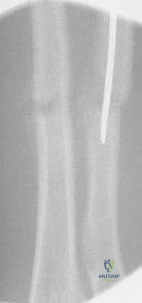 صورة توضيحية لـ كسور عظمي الساعد عند الأطفال: العلاج المتقدم بالمسامير المرنة داخل النخاع مع الأستاذ الدكتور محمد هطيف