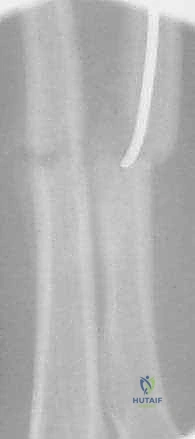 صورة توضيحية لـ كسور عظمي الساعد عند الأطفال: العلاج المتقدم بالمسامير المرنة داخل النخاع مع الأستاذ الدكتور محمد هطيف