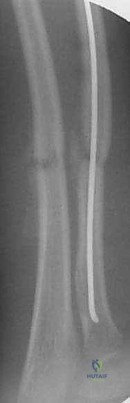 صورة طبية: كسور عظمي الساعد عند الأطفال: العلاج المتقدم بالمسامير المرنة داخل النخاع مع الأستاذ الدكتور محمد هطيف