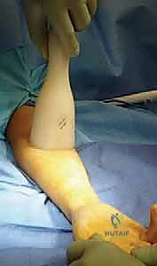 صورة طبية: كسور عظمي الساعد عند الأطفال: العلاج المتقدم بالمسامير المرنة داخل النخاع مع الأستاذ الدكتور محمد هطيف