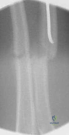 صورة طبية: كسور عظمي الساعد عند الأطفال: العلاج المتقدم بالمسامير المرنة داخل النخاع مع الأستاذ الدكتور محمد هطيف