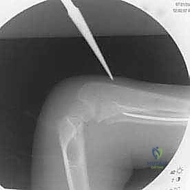 صورة طبية: كسور عظمي الساعد عند الأطفال: العلاج المتقدم بالمسامير المرنة داخل النخاع مع الأستاذ الدكتور محمد هطيف