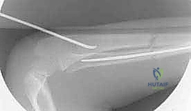 صورة طبية: كسور عظمي الساعد عند الأطفال: العلاج المتقدم بالمسامير المرنة داخل النخاع مع الأستاذ الدكتور محمد هطيف