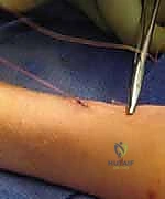 صورة طبية: كسور عظمي الساعد عند الأطفال: العلاج المتقدم بالمسامير المرنة داخل النخاع مع الأستاذ الدكتور محمد هطيف