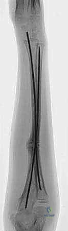 Pediatric Forearm Shaft Fractures: Flexible Intramedullary Nailing Masterclass