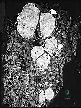 أشعة مقطعية للساركوما