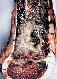 صورة توضيحية لـ دليل شامل لاستئصال الساركوما: فهم البيولوجيا، تحديد المراحل، ومبادئ الحفاظ على الأطراف مع الأستاذ الدكتور محمد هطيف