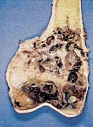 تقييم حالة الساركوما