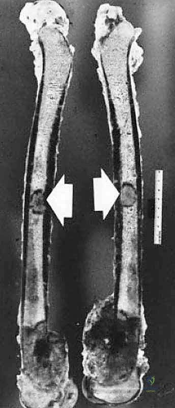 الكبسولة الكاذبة للورم