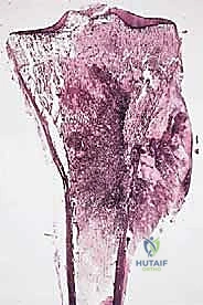 الفحص السريري للساركوما