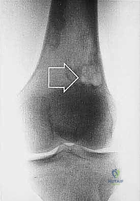 ترقيع الجلد
