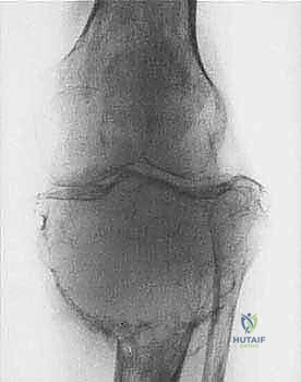 أعراض أورام العظام