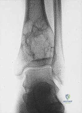 إعادة بناء العظم