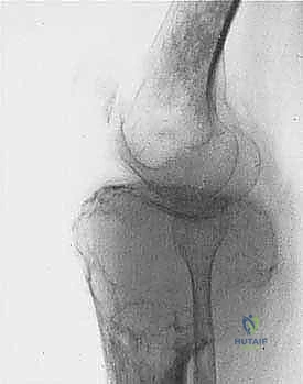 صورة طبية: دليل شامل لاستئصال الساركوما: فهم البيولوجيا، تحديد المراحل، ومبادئ الحفاظ على الأطراف مع الأستاذ الدكتور محمد هطيف