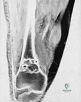 صورة طبية: دليل شامل لاستئصال الساركوما: فهم البيولوجيا، تحديد المراحل، ومبادئ الحفاظ على الأطراف مع الأستاذ الدكتور محمد هطيف