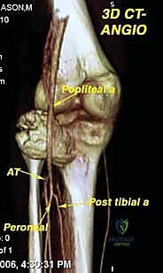 صورة طبية: دليل شامل لاستئصال الساركوما: فهم البيولوجيا، تحديد المراحل، ومبادئ الحفاظ على الأطراف مع الأستاذ الدكتور محمد هطيف