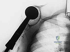 تطور تقنيات استئصال أورام العظام