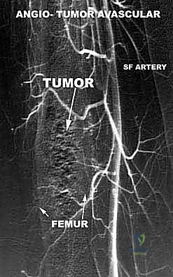 العلاج الإشعاعي