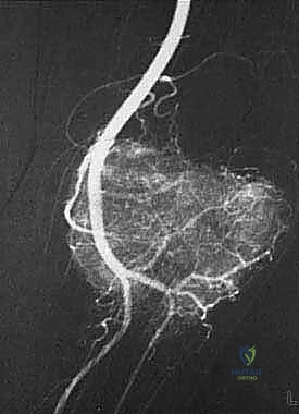 صورة توضيحية لـ دليل شامل لاستئصال الساركوما: فهم البيولوجيا، تحديد المراحل، ومبادئ الحفاظ على الأطراف مع الأستاذ الدكتور محمد هطيف