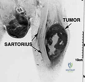 صورة طبية: دليل شامل لاستئصال الساركوما: فهم البيولوجيا، تحديد المراحل، ومبادئ الحفاظ على الأطراف مع الأستاذ الدكتور محمد هطيف