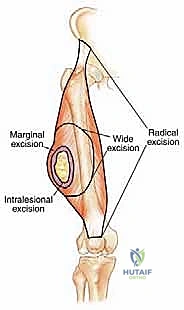 صورة طبية: دليل شامل لاستئصال الساركوما: فهم البيولوجيا، تحديد المراحل، ومبادئ الحفاظ على الأطراف مع الأستاذ الدكتور محمد هطيف