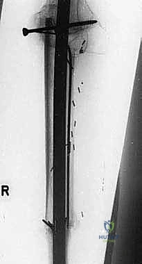 مفصل التيتانيوم