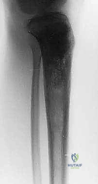 صورة طبية: دليل شامل لاستئصال الساركوما: فهم البيولوجيا، تحديد المراحل، ومبادئ الحفاظ على الأطراف مع الأستاذ الدكتور محمد هطيف