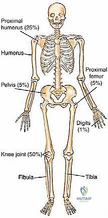 إعادة التأهيل بعد الجراحة