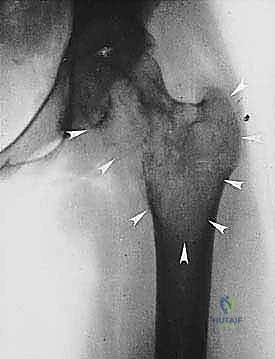 صورة طبية: دليل شامل لاستئصال الساركوما: فهم البيولوجيا، تحديد المراحل، ومبادئ الحفاظ على الأطراف مع الأستاذ الدكتور محمد هطيف