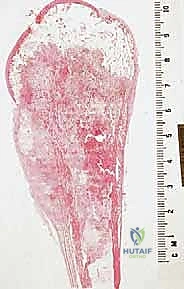 انتشار الورم