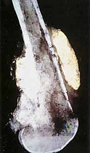 المفاصل الصناعية الكبيرة