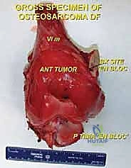 تغطية الأنسجة الرخوة