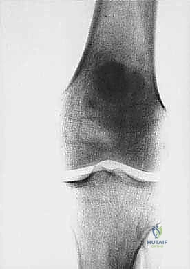 تصوير الكتلة الورمية