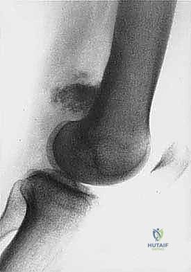 صورة توضيحية لـ دليل شامل لاستئصال الساركوما: فهم البيولوجيا، تحديد المراحل، ومبادئ الحفاظ على الأطراف مع الأستاذ الدكتور محمد هطيف