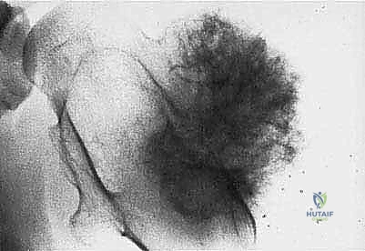 الاستئصال الجذري