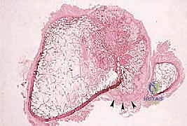 تقييم استجابة الورم