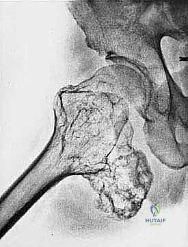 صورة طبية: دليل شامل لاستئصال الساركوما: فهم البيولوجيا، تحديد المراحل، ومبادئ الحفاظ على الأطراف مع الأستاذ الدكتور محمد هطيف