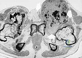 الجراحة الميكروسكوبية الدقيقة