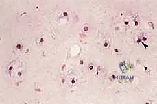 صورة طبية: دليل شامل لاستئصال الساركوما: فهم البيولوجيا، تحديد المراحل، ومبادئ الحفاظ على الأطراف مع الأستاذ الدكتور محمد هطيف