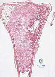 صورة طبية: دليل شامل لاستئصال الساركوما: فهم البيولوجيا، تحديد المراحل، ومبادئ الحفاظ على الأطراف مع الأستاذ الدكتور محمد هطيف