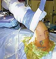 تشريح مفصل الكتف والأوتار المحيطة