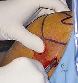 تجهيز الأدوات الجراحية الدقيقة والمناظير