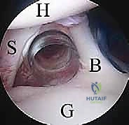 صورة توضيحية لـ منظار الكتف: دليلك الشامل لفهم الإجراء والتعافي مع الأستاذ الدكتور محمد هطيف