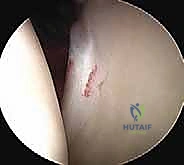 صورة طبية: منظار الكتف: دليلك الشامل لفهم الإجراء والتعافي مع الأستاذ الدكتور محمد هطيف