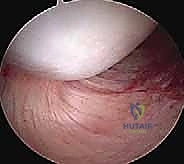 صورة توضيحية لـ منظار الكتف: دليلك الشامل لفهم الإجراء والتعافي مع الأستاذ الدكتور محمد هطيف